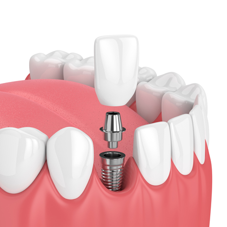Single & Multiple Implants