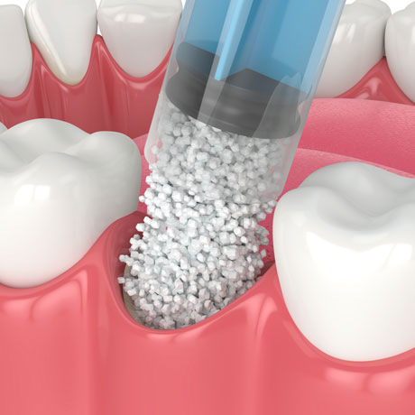 Sinus Lift & Bone Grafting